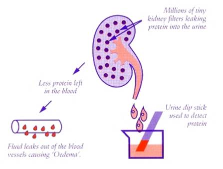  Nephrotic_Syndrome (1).jpg